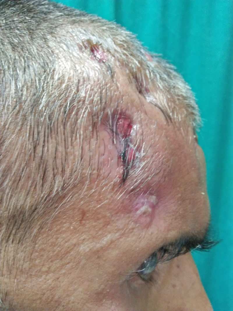 Figure 2: Multiple draining sinuses over frontal and temporal area of scalp.