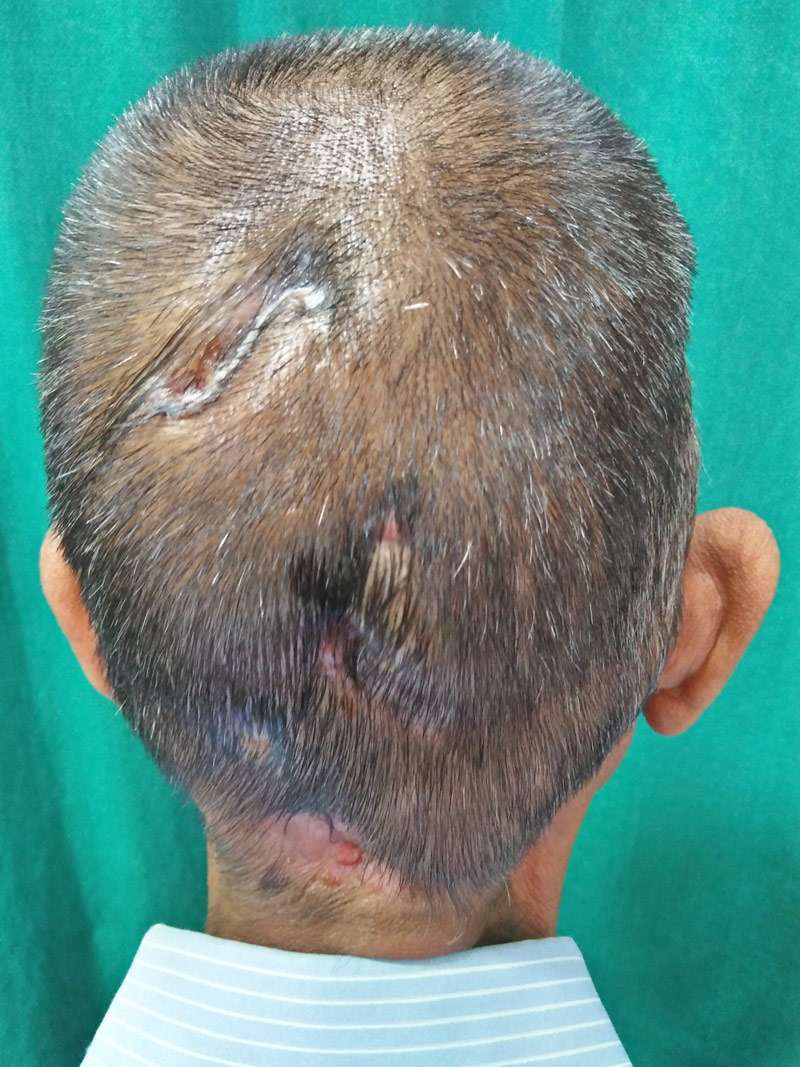 Figure 3: Multiple draining sinuses over occipital area of scalp.