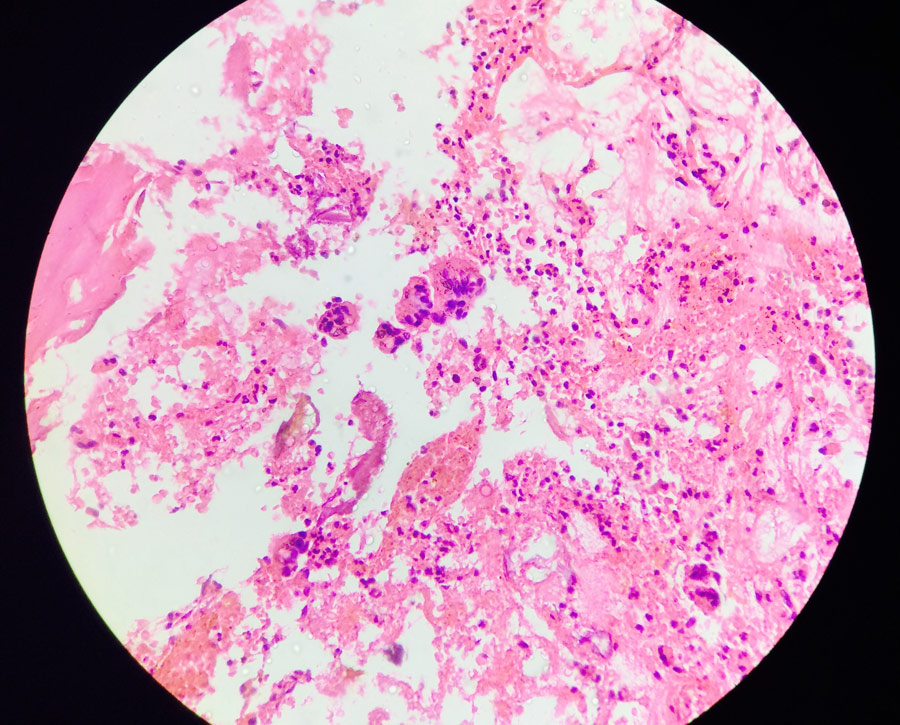 Figure 4: On histopathology Intertrabecular spaces showed mixed inflammatory infiltrate with presence of giant cells (H&E,10X).