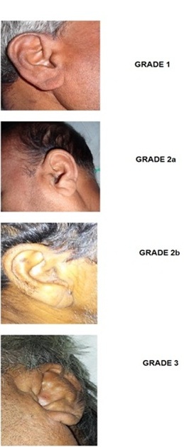 Figure 3: Grades Of Diagonal Ear Lobe Crease 
