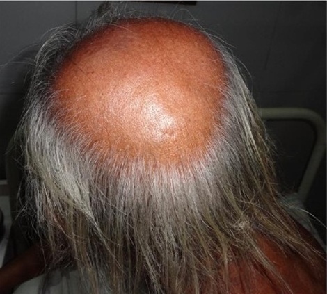 Figure 5: Vertex Alopecia
  