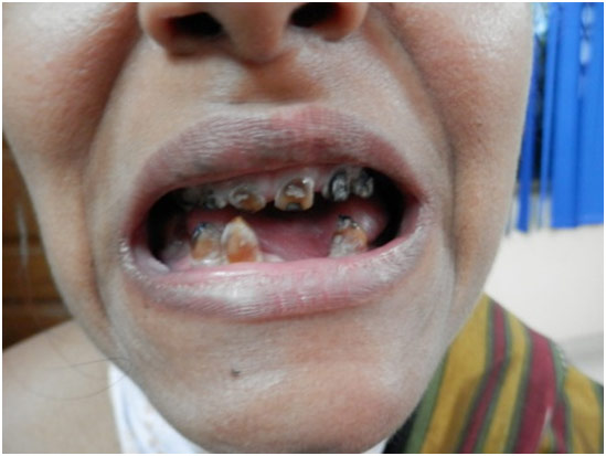 Figure 5: Loss of teeth, discolored and distorted teeth with caries.