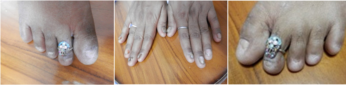 Figure 6: (a, b &c) - Twenty nail dystrophy